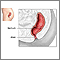 Rectal prolapse repair - series Rectal prolapse repair - series