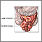 Small bowel resection - series Small bowel resection - series