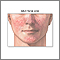 Adult facial acne Adult facial acne