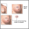 Excision of breast lump Excision of breast lump