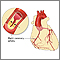 Coronary artery disease Coronary artery disease