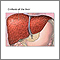 Cirrhosis of the liver Cirrhosis of the liver