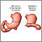 Gastrectomy Gastrectomy