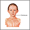 Chickenpox Chickenpox