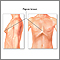 Bowed chest (pigeon breast) Bowed chest (pigeon breast)