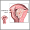 Endometrial cancer Endometrial cancer