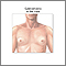Gynecomastia Gynecomastia