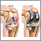 Knee joint replacement prosthesis Knee joint replacement prosthesis