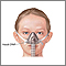 Nasal CPAP Nasal CPAP