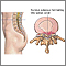Herniated nucleus pulposus Herniated nucleus pulposus