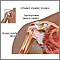 Inflamed shoulder tendons Inflamed shoulder tendons