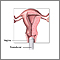 Transvaginal ultrasound Transvaginal ultrasound