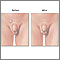 Before and after testicular repair Before and after testicular repair