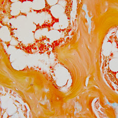 Bone Marrow Diseases