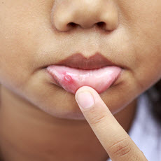 Canker Sores