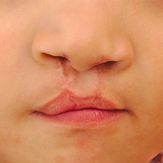 Cleft Lip and Palate