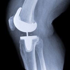 Knee Replacement