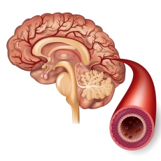Transient Ischemic Attack