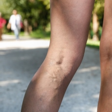 Varicose Veins