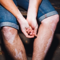 Vitiligo