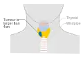 Stage T3 thyroid cancer