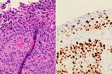 Invasive cervical squamous cell carcinoma on H&E histopathology and Ki-67 immunohistochemistry. The latter correlates well with the degree and level of dysplasia.