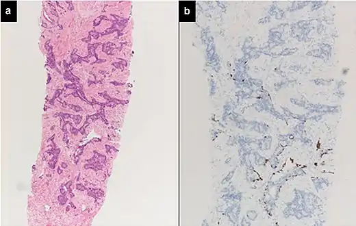Intraductal carcinoma of the prostate with very patchy basal cells identified by immunohistochemistry. At least some of the glands lacking basal cell immunoreactivity represent intraductal rather than invasive carcinoma (a haematoxylin and eosin, b CK 5/6)