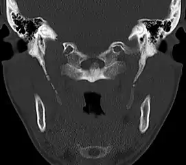 CT scan, coronal section showing bilateral extended styloid process and stylohyoid ligament ossification (incidental finding)